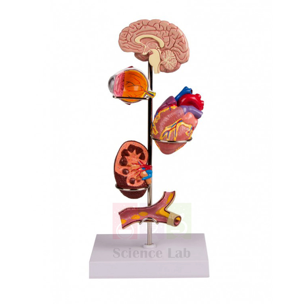 Human Hypertension Model